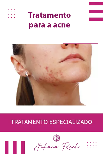 tratamento da acne