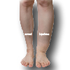 Lipedema