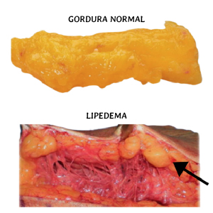 Lipedema